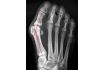 Correcteur Nocturne Hallux-Valgus Gauche Taille L. Pointure 41 - 46 - vignette 3