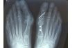 Correcteur Nocturne Hallux-Valgus Gauche Taille L. Pointure 41 - 46 - vignette 5